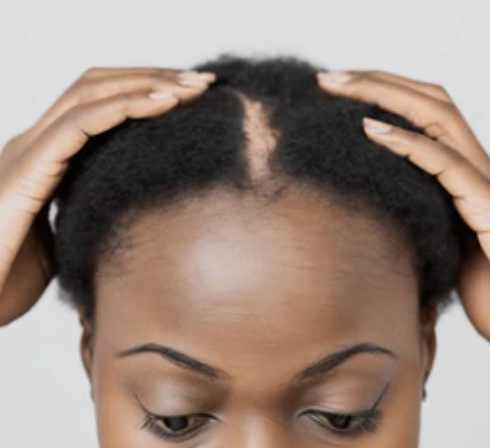 Black woman experiencing hair loss and thinning due to vitamin D, iron, and zinc deficiency - natural hair health concerns